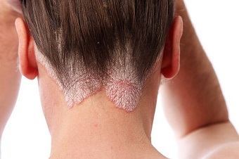 Scalp Ringworm and Its Treatments